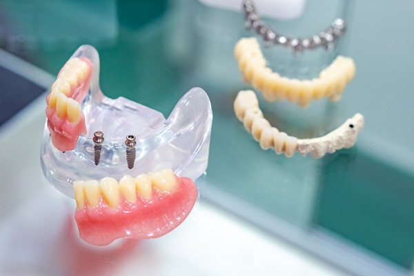 Are Mini Dental Implants Permanent?