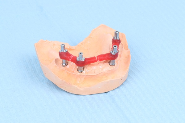 Caring For Your Mini Dental Implants: Tips For Long Lasting Results