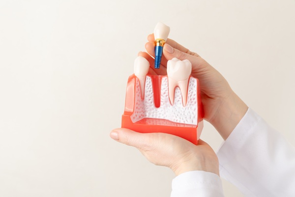 Can You Whiten Tooth Implants?